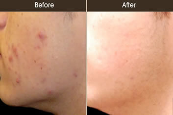 Acne Treatment Before And After