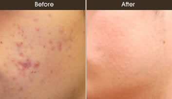 Acne Treatment Results