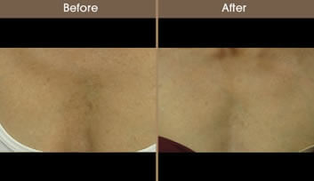 Before And After Sun Damage Treatment