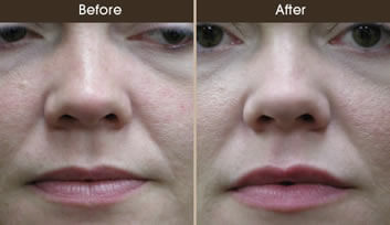 Lip Augmentation Before And After Front View