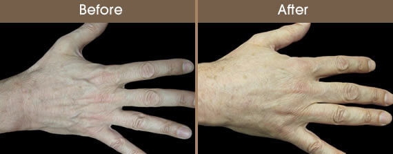 Hand Rejuvenation Before And After