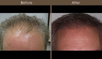 Hair Restoration Front View