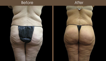 Buttocks Augmentation Before And After