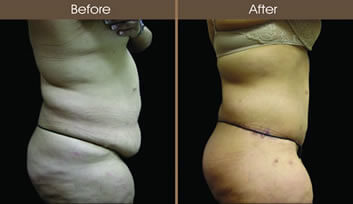 Post-Bariatric Surgery Before And After