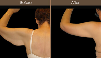 Arm Lift Before And After Back Image