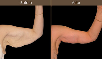 Arm Lift Before And After Front Image