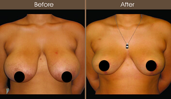 Breast Reduction Before And After Front View
