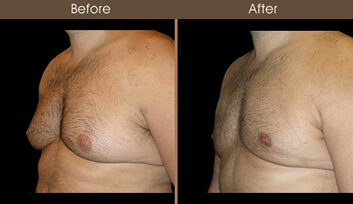 Male Breast Reduction Before And After Quarter View