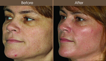Sun Damage Treatment Before And After Quarter View