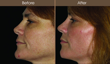 Sun Damage Treatment Before And After Side View