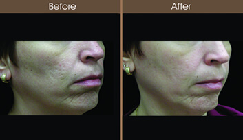Skin Resurfacing Before And After Right Side View