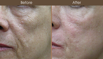Before And After Laser Skin Resurfacing