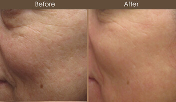 Before And After Skin Resurfacing