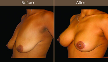 Breast Lift Before And After Quarter Image
