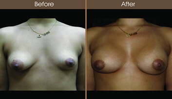 Breast Asymmetry Before And After