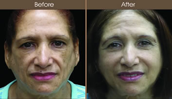 Sculptra Before And After