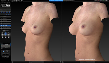 Vectra 3D Imaging Before And After