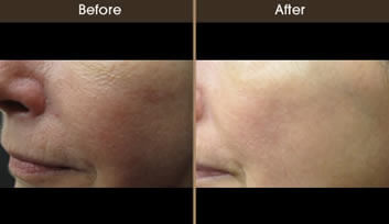 Before And After Rosacea Treatment