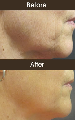 Before And After Skin Tightening