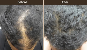 Hair Loss Treatment Before And After Top View