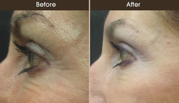 Before And After Botox Treatment