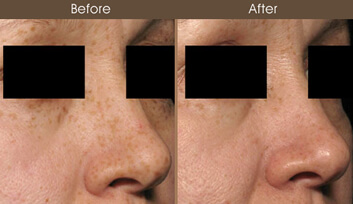 Skin Resurfacing Results
