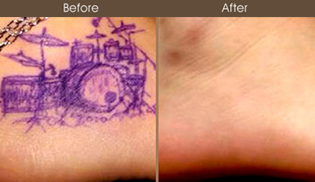 Tattoo Removal Before And After