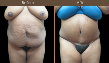 New York Abdominoplasty Surgery Before And After
