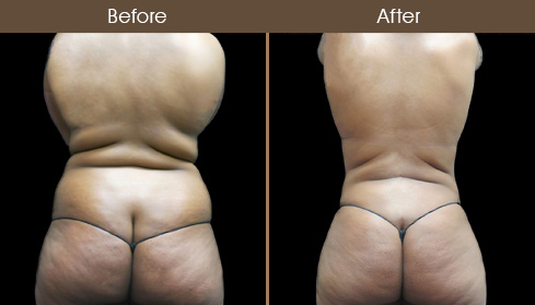 Body Sculpting Before & After Gallery 16
