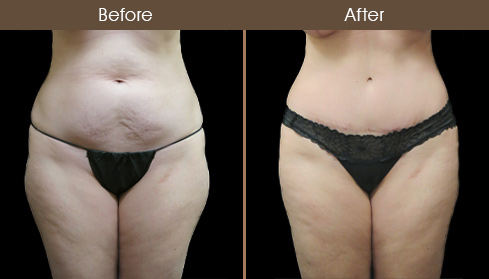 NYC Tummy Tuck Surgery Before And After