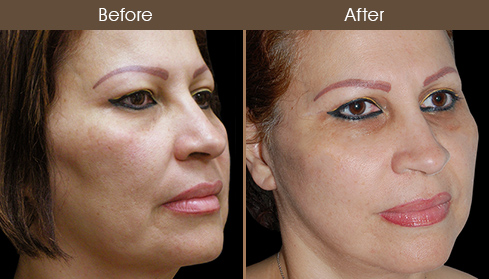 Before & After Face Lift Surgery