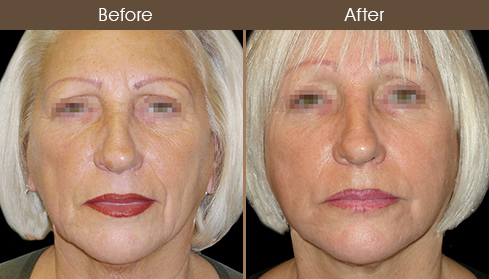 Facelift Treatment Before & After
