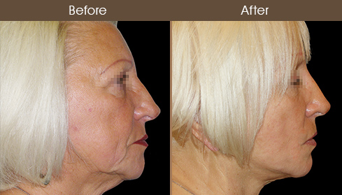 Facelift Treatment Results