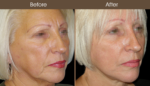 Before And After Facelift Treatment
