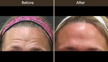 Botox Cosmetic Results