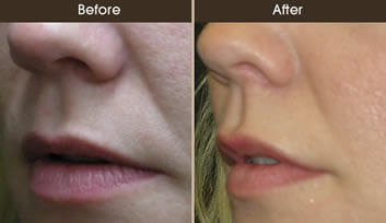 Lip Augmentation Before And After Quarter View