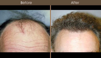 Hair Restoration Front Image