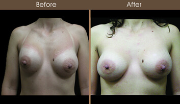 Revision Breast Surgery Before And After