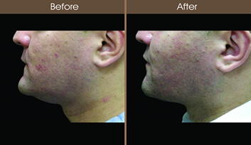 Neck Liposuction Before And After