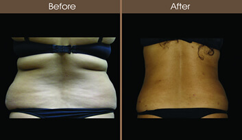 SmartLipo Before And After Back View
