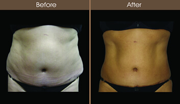 SmartLipo Before And After Front View