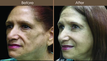 Before And After Sculptra Treatment