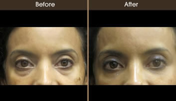 Restylane Treatment Before And After