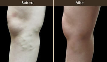 Sclerotherapy Results