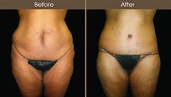 Lower Body Lift Before & After Patient 78, NYC