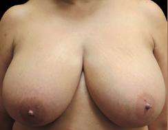 Breast Reduction Before & After Patient #1423