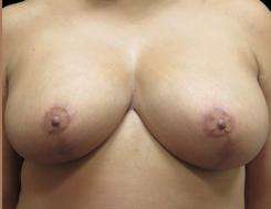 Breast Reduction Before & After Patient #1423