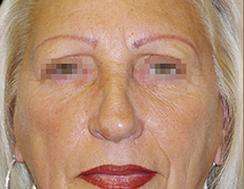 Browlift Before & After Patient #1461