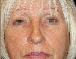 Browlift Before & After Patient #1461