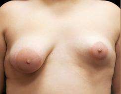 Breast Asymmetry Before & After Patient #943